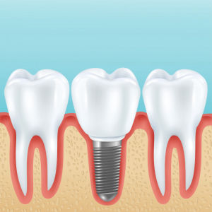 Mersin implant tedavisi